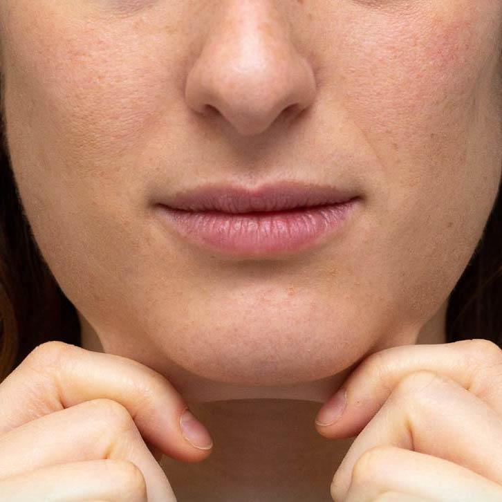 Service Thread Lift: Redefining Youthful Contours Without Surgery Image