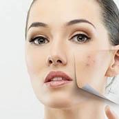 Service ACNE SCARS Image
