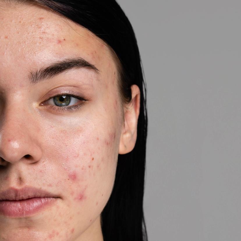 Service Acne Treatements Image