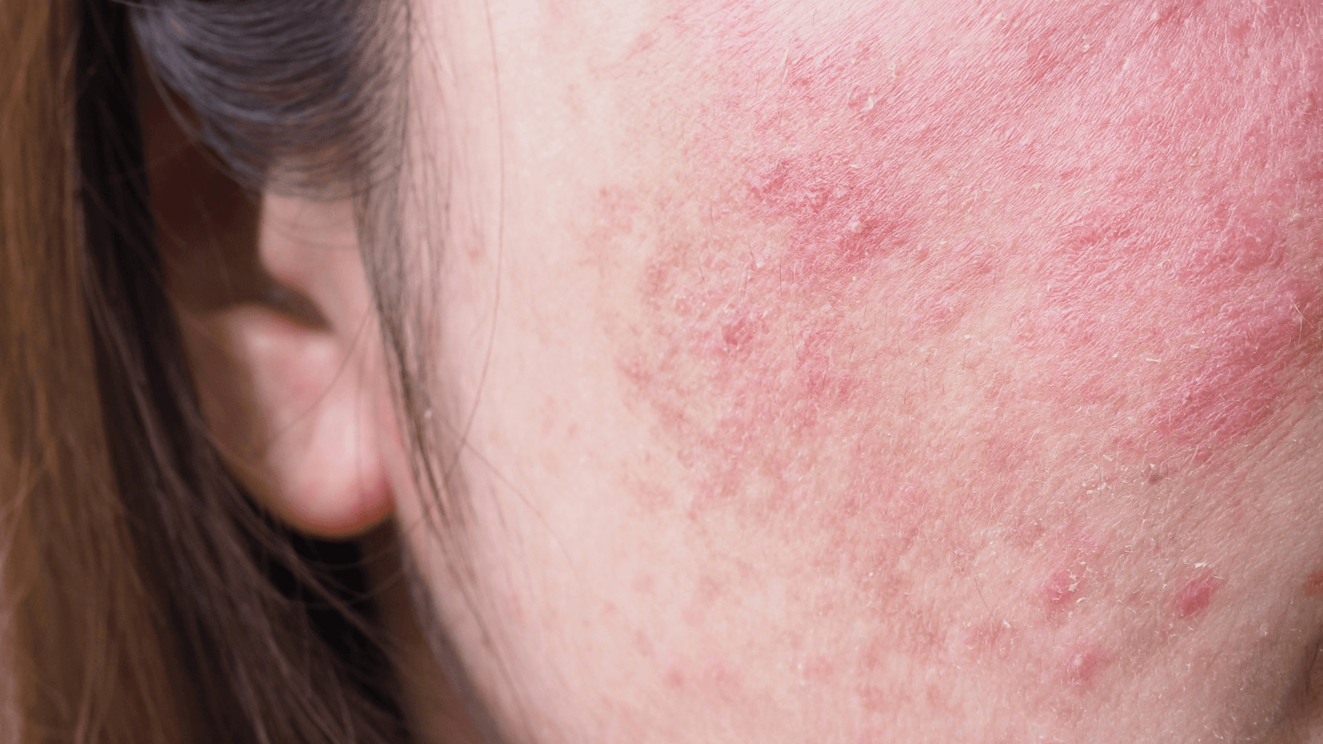 Blog: What Is Sensitive Skin? Causes, Proper Care, and Long-Term Solutions for a Stronger Skin Barrier