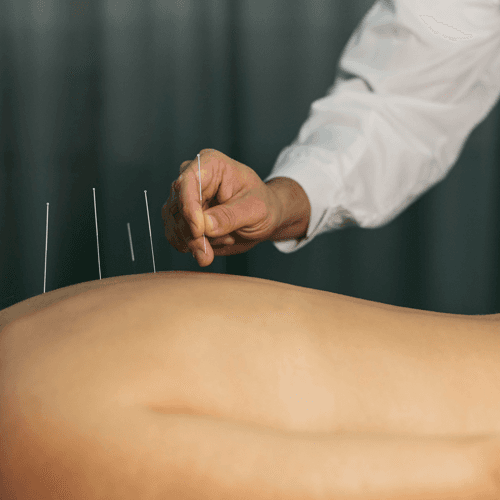 Service Rediscover Balance and Wellness with Acupuncture Image