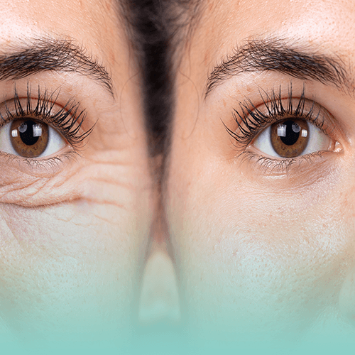 Service Youthful Eyes Reborn: Lower-Blepharoplasty for Under-Eye Rejuvenation Image