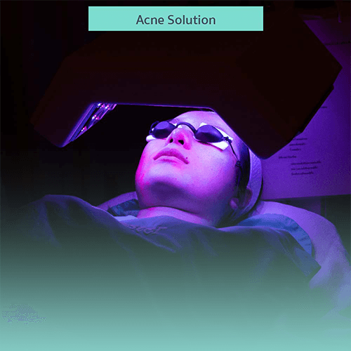 Service Acne Solution: Clear Skin Starts Here Image