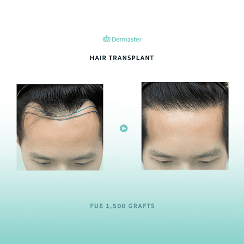 Service Hair Transplant Using FUE Technique Image