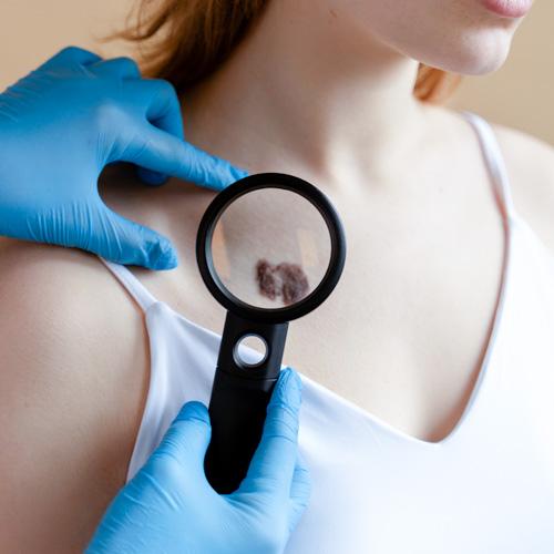 Service Mole and Nevus Removal Image