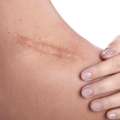 Service Stretch Mark and Scar Removal Image