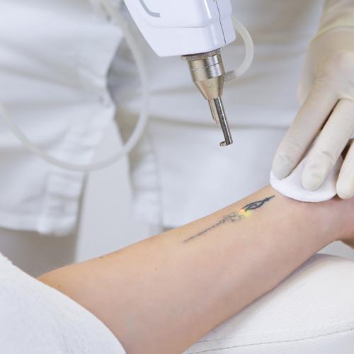 Service Tattoo Removal Image