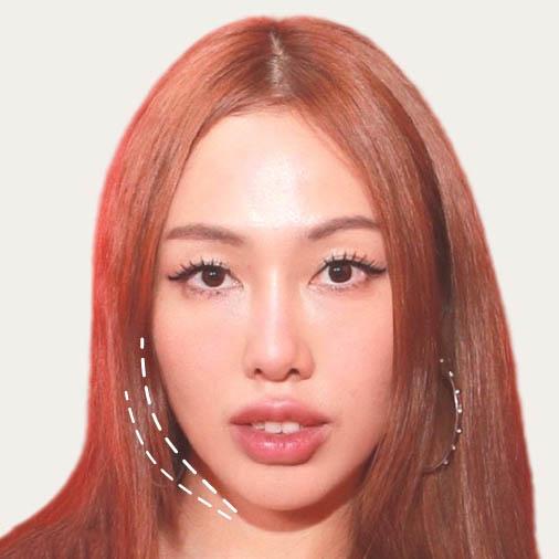 Service Botox at Nicha Clinic: Your Path to Timeless Beauty Image