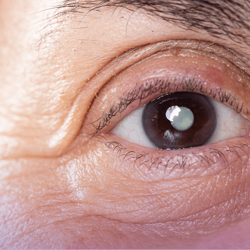 Service Cataract Surgery (Phacoemulsification with IOL) Image
