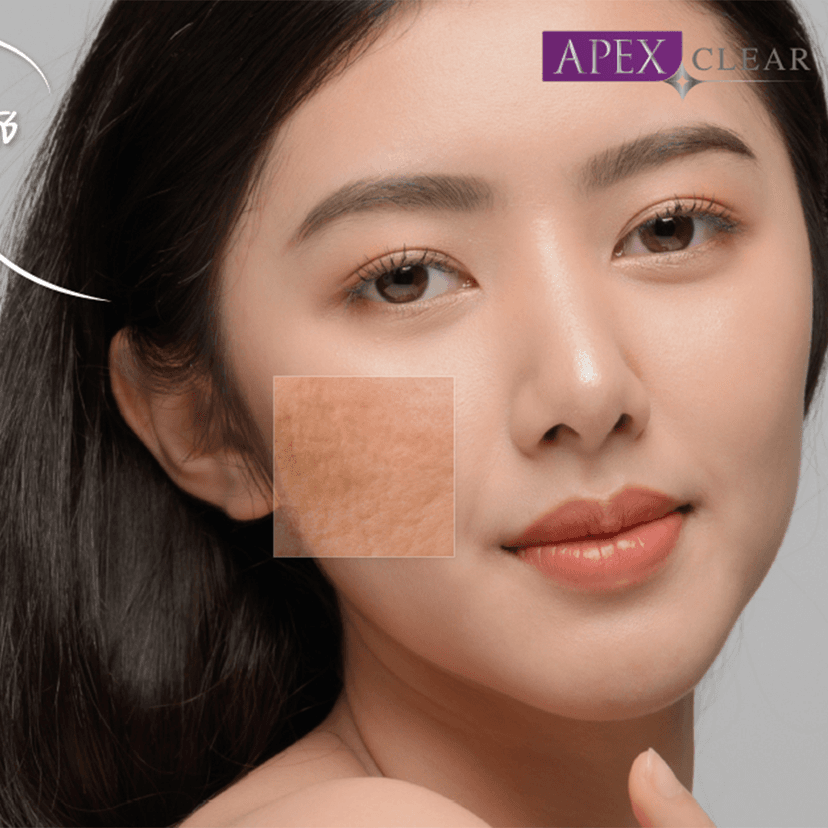 Service Clear Smooth Program: The Ultimate Solution for Acne Scars Image