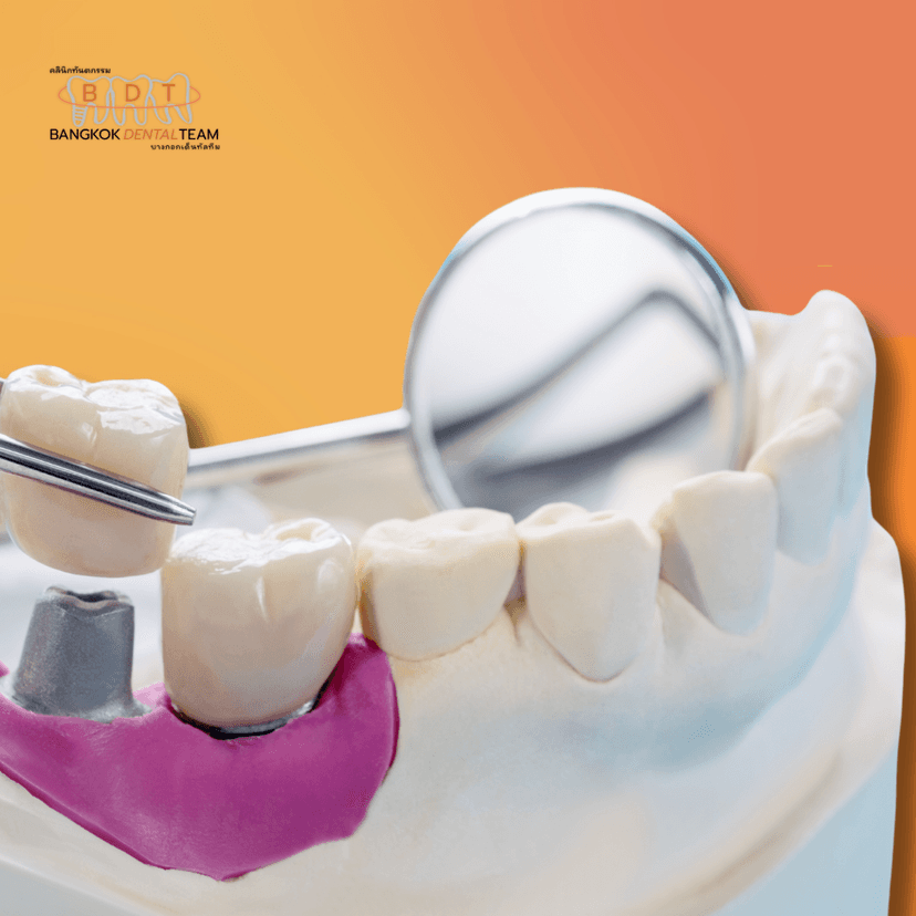 Service Dental Implants Image