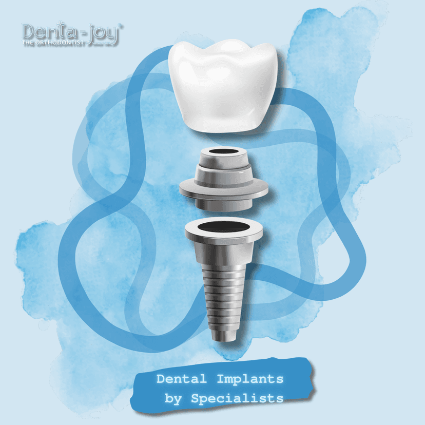 Service Dental Implants by Specialists Image
