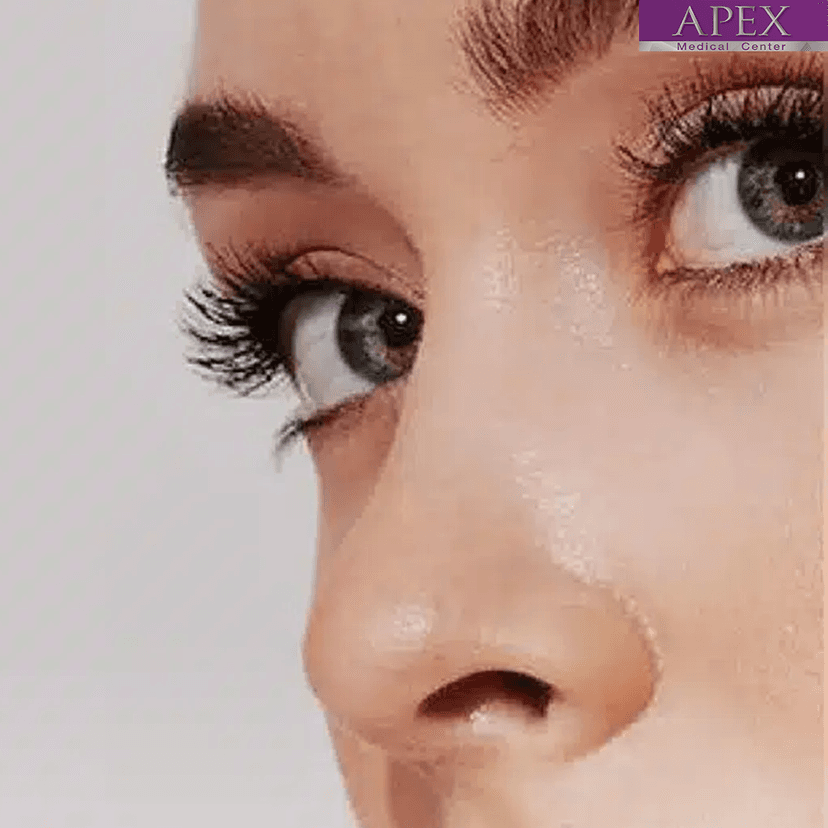Service Filler Threads: The Next Evolution in Non-Surgical Facial Rejuvenation Image