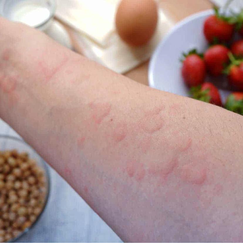 Service Food intolerance test (IgG) 108 Food allergens Image