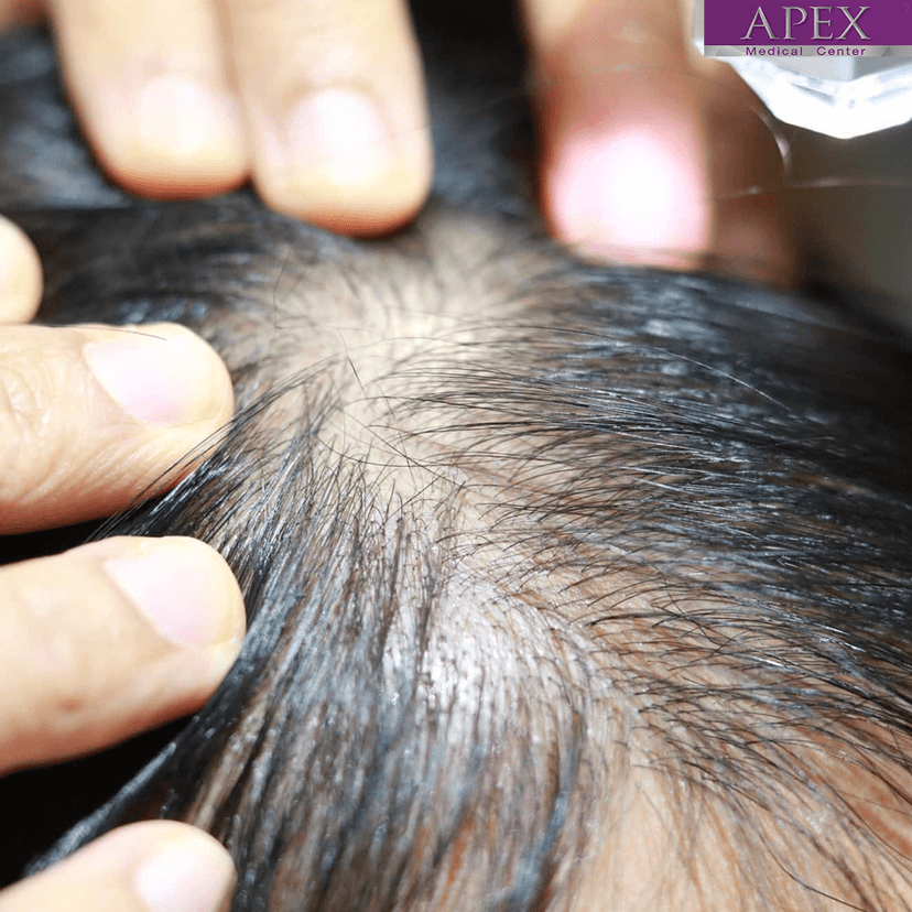 Service Hair Stem Micro Transplant Image