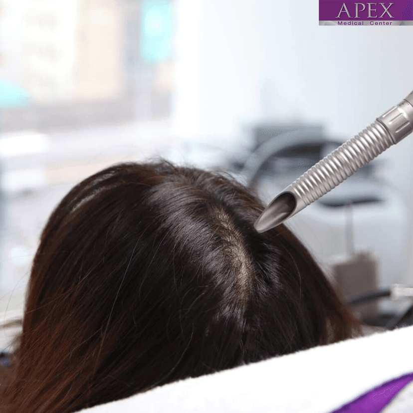 Service LASER MESO HAIR (LMH): Advanced Laser Technology for Hair and Scalp Health Image