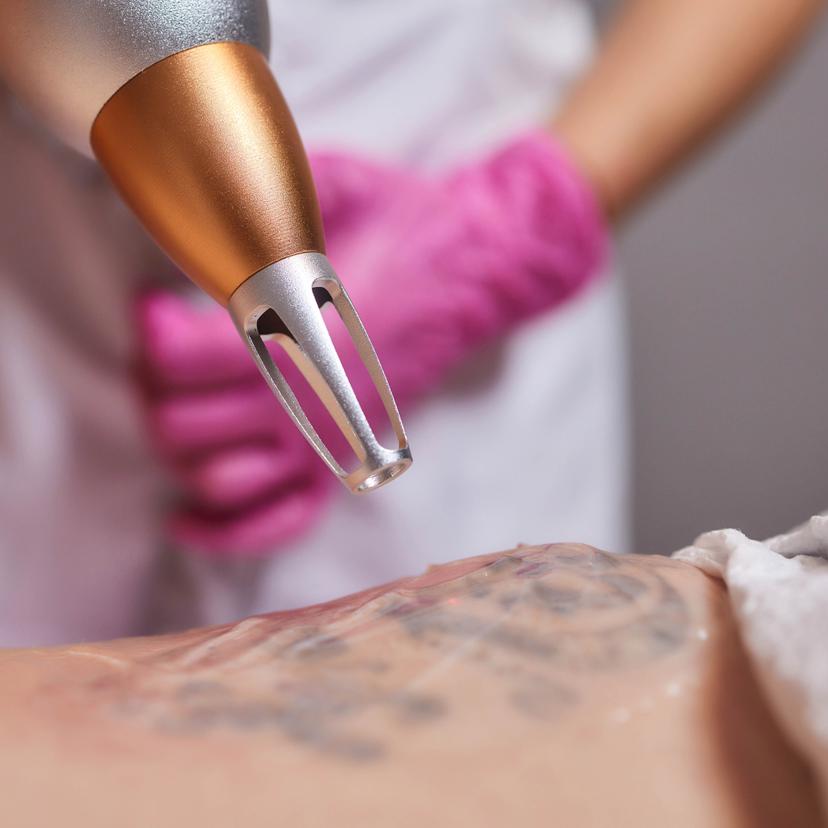 Service Laser Tattoo Removal Image