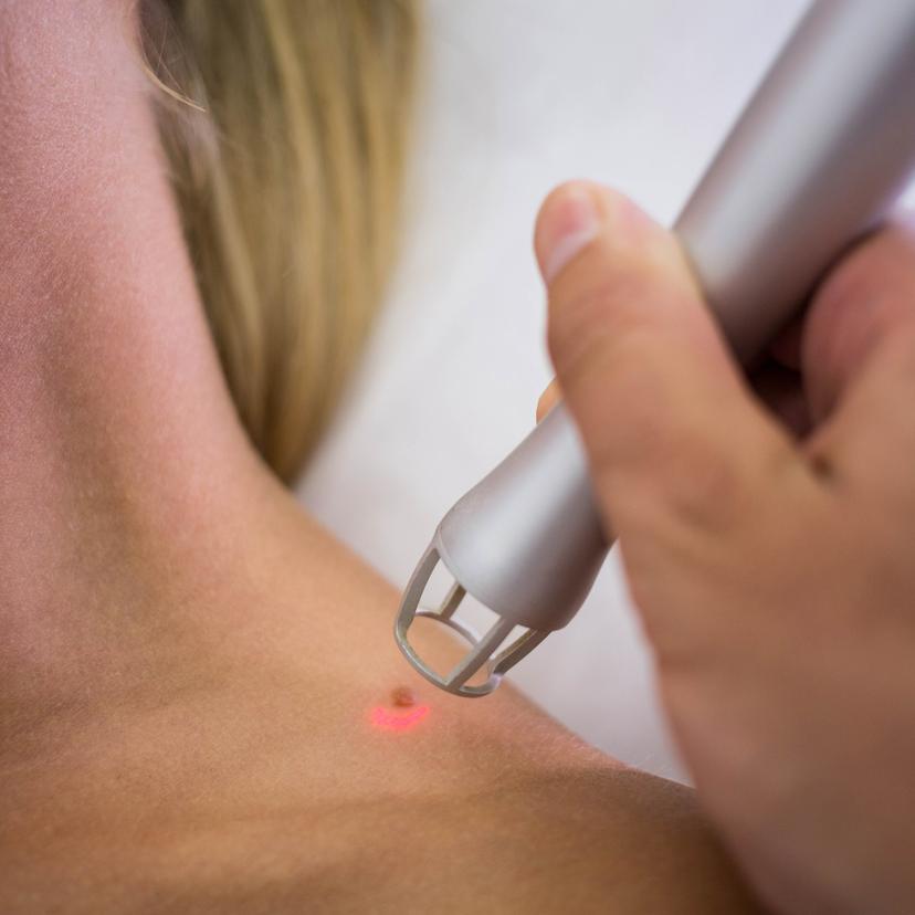 Service Mole (Nevus) and Skin tag (Polyps) Removal Image