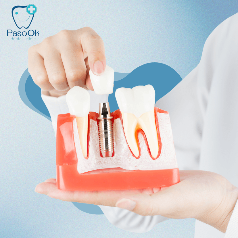 Service Root Canal Treatment Image