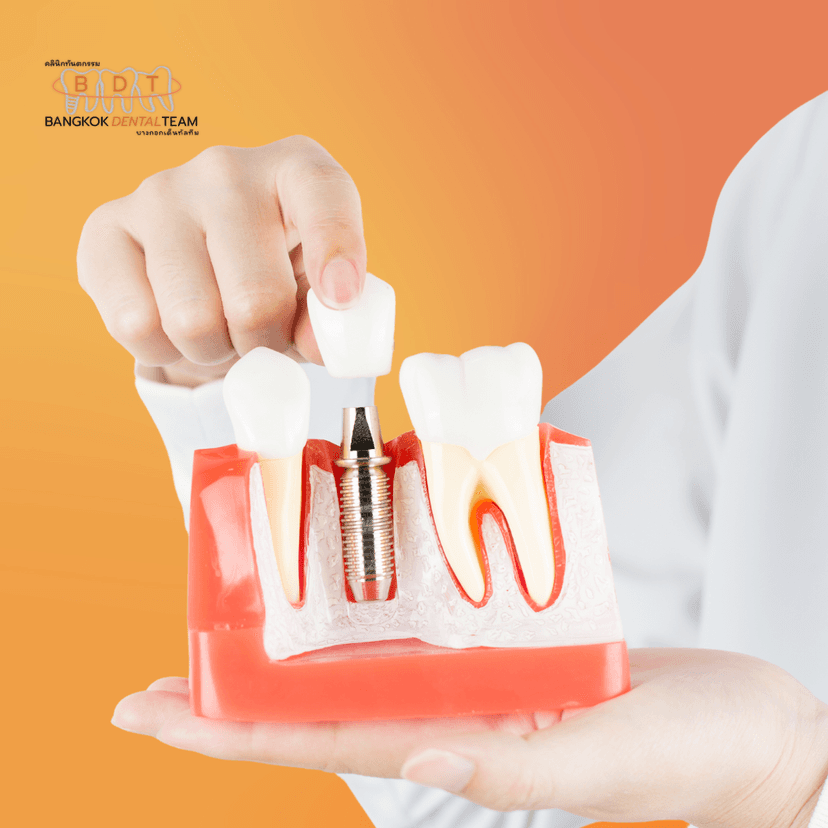Service Root Canal Treatment Image