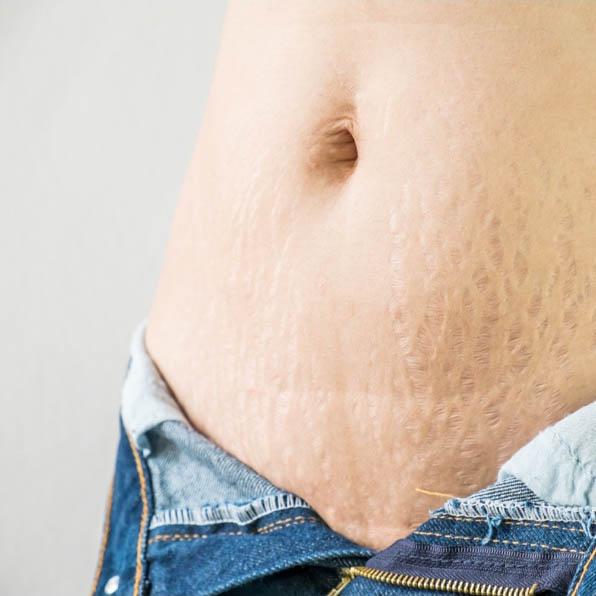 Service STRETCH MARKS Image
