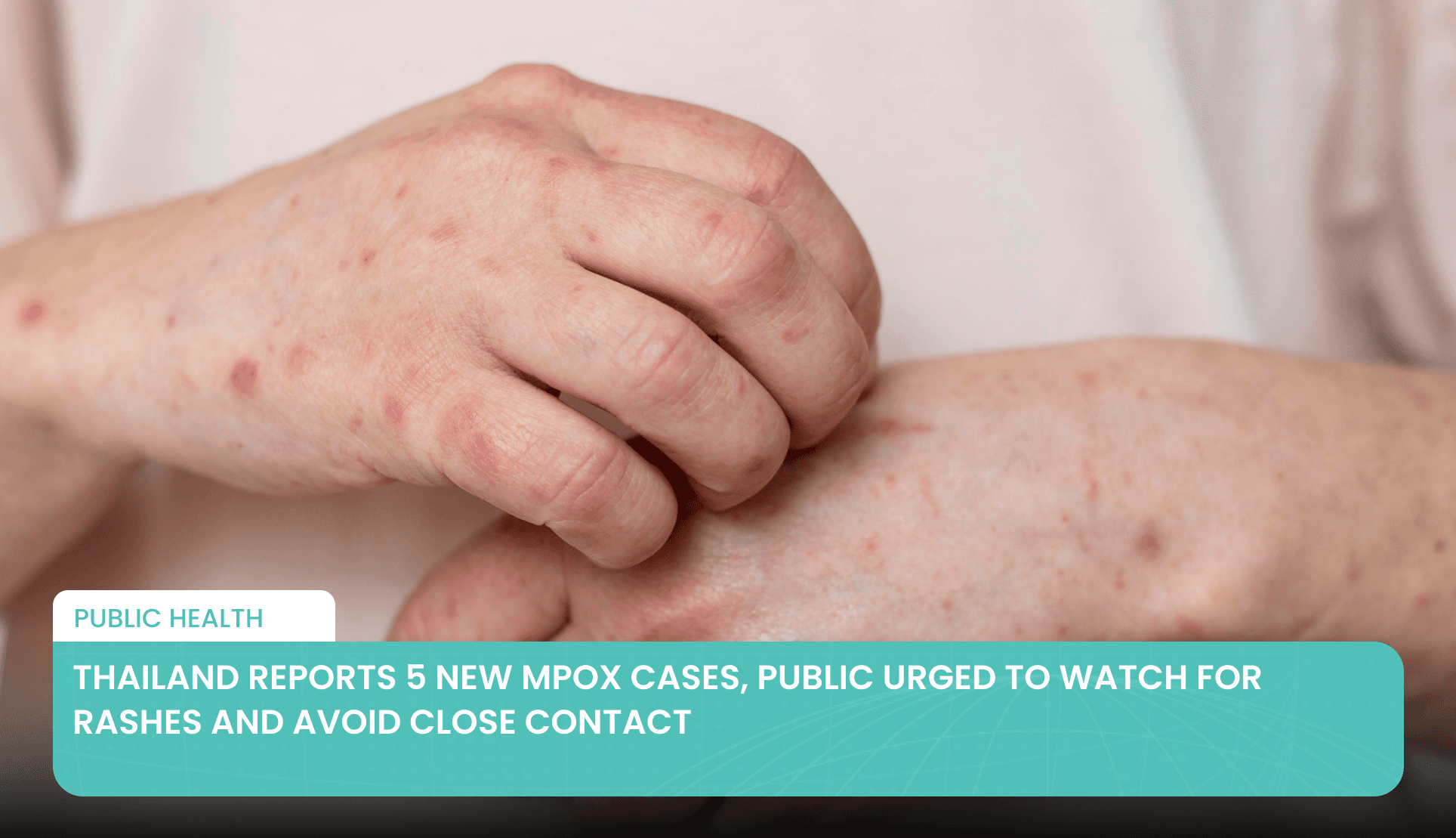 Thailand Reports 5 New Mpox Cases, Public Urged to Watch for Rashes and Avoid Close Contact's featured image