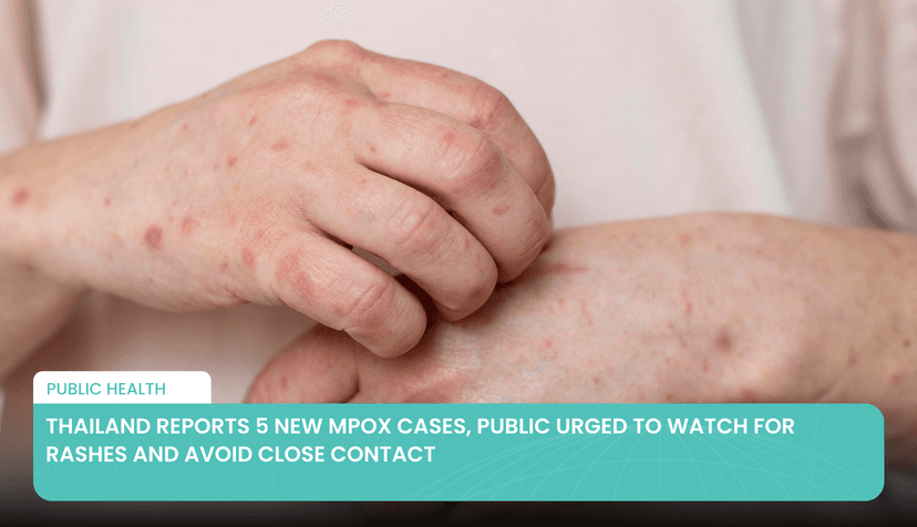Logo for News - Thailand Reports 5 New Mpox Cases, Public Urged to Watch for Rashes and Avoid Close Contact