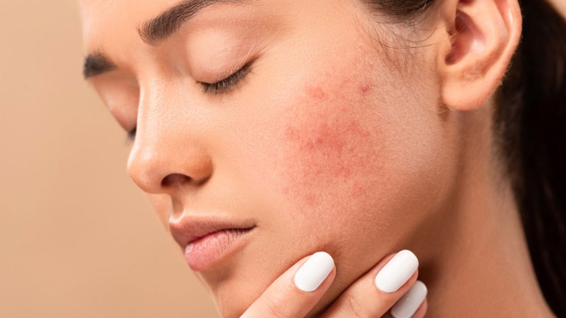 Blog: The Battle Against Acne Scars: Causes and Treatments