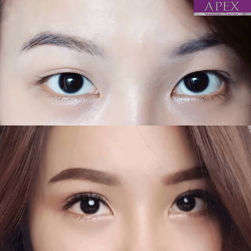 Service Celeb Eyes: Korean Double Eyelid Surgery for Natural, Stunning Results Image