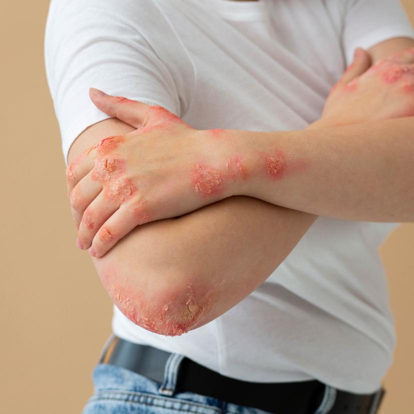 Service Psoriasis Image