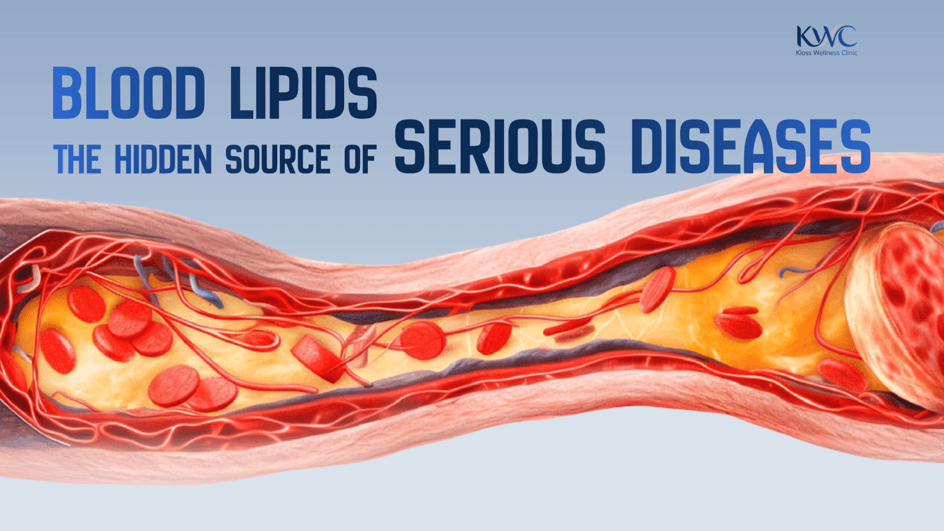 Blog: Blood Lipids: The Hidden Source of Serious Diseases